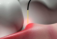 Lasers for Dental