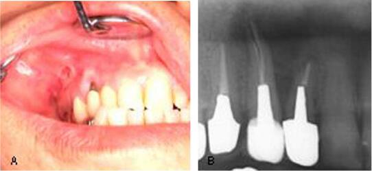 Mediastinal emphysema caused by a dental laser